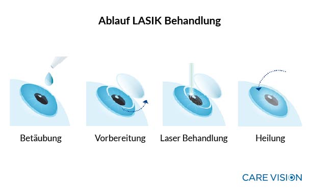 Warum Kunstlicht der größte Feind des Fans ist – und wie LASIK das ändert Warum Kunstlicht der größte Feind des Fans ist – und wie LASIK das ändert