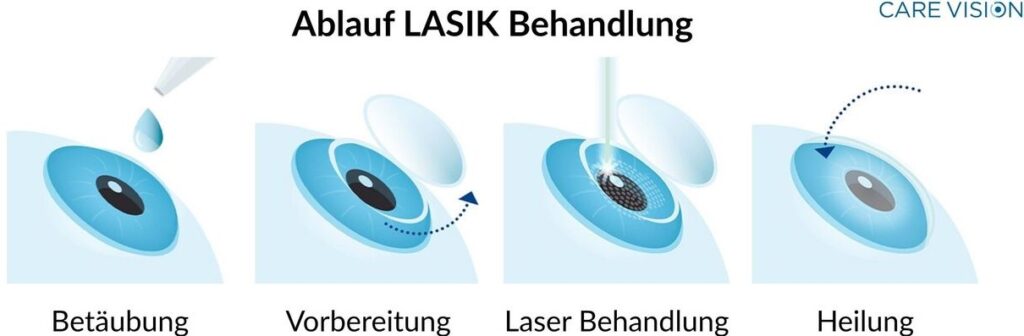 Warum Kunstlicht der größte Feind des Fans ist – und wie LASIK das ändert LASIK das ändert